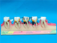 牙科模型 牙周病演变模型 齿科口腔材料4010